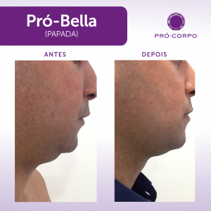 Pró-Bella Papada Antes e Depois